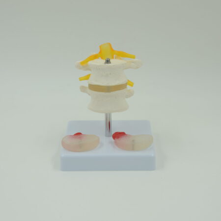 School Stationery Supplies Biology : 2 Lumbar Vertebra With Hernia And Prolaped Invertebral Disc - Image 1