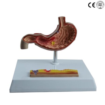 Biology : Diseased Stomach Model - Image 1