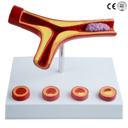 Biology : Atherosclerosis Model With Thrombus - Image 1